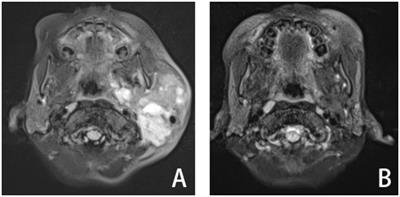 Management for lymphatic malformations of head and neck